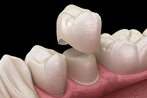 computer illustration of a dental crown in Castle Shannon