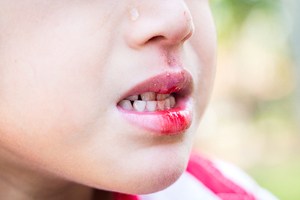 child with a bleeding lip