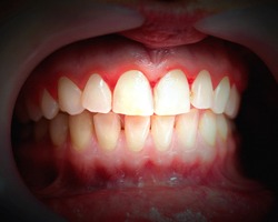 Gum disease