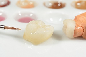 Dental crown restortion on model tooth