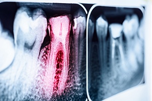 Dental x-rays with red highlighted tooth