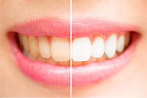 A closeup before and after photo for teeth whitening treatment.