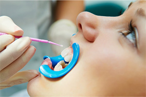 A woman receiving whitening treatment.