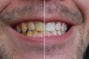 Before and after teeth whitening at cosmetic dentist in Castle Shannon.